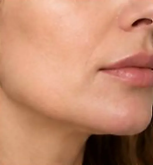 Contorno facial después del tratamiento de inducción de colágeno