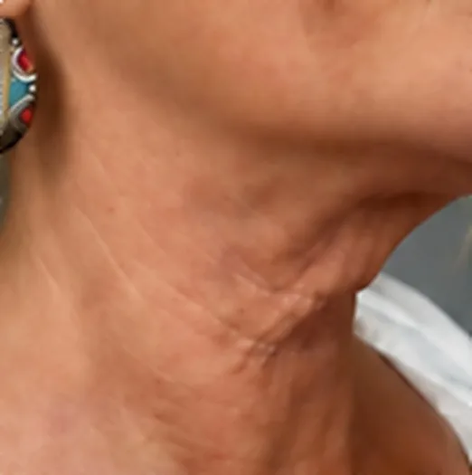 Cuello de perfil antes del tratamiento de HIFU facial