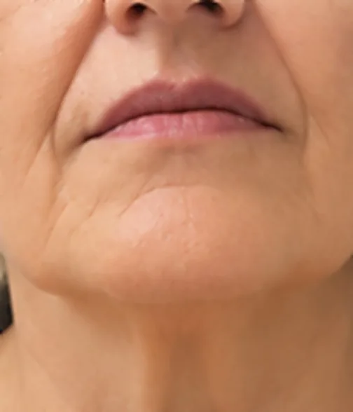 Mentón y mandíbula antes del tratamiento de HIFU facial