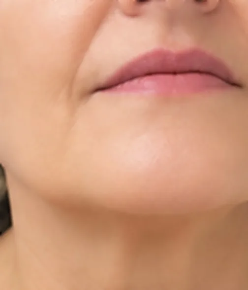 Mentón y mandíbula después del tratamiento de HIFU facial