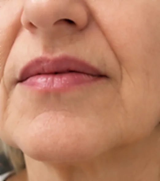 Surcos y óvalo facial antes del tratamiento de HIFU facial