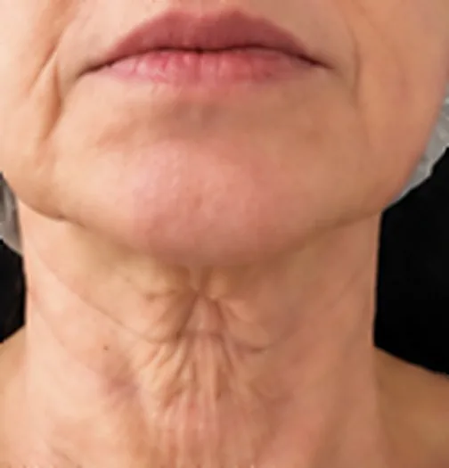 Cuello y papada antes del tratamiento de HIFU facial