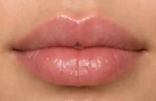 Labios después del relleno con ácido hialurónico