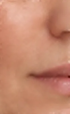 Mejilla antes del tratamiento de rejuvenecimiento facial