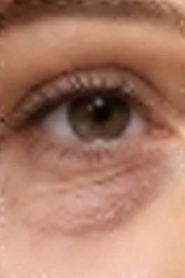 Contorno de ojos antes del tratamiento de rejuvenecimiento facial