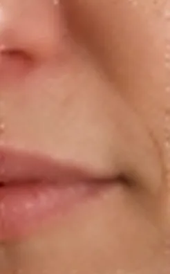 Surcos antes del tratamiento de rejuvenecimiento facial